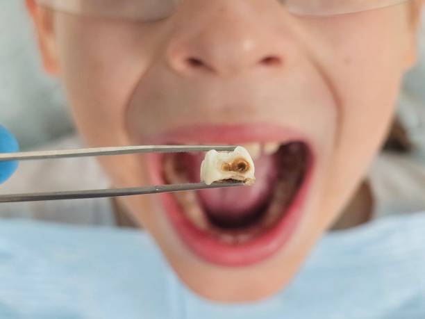 Best Dental Abscess Treatment in Springfield, NE