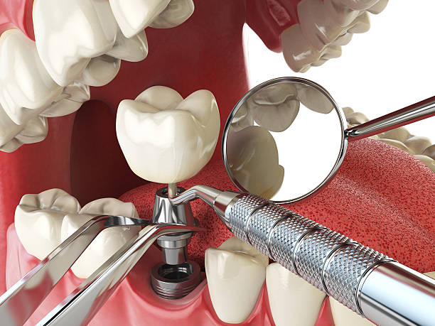 Best Dental Abscess Treatment in Springfield, NE